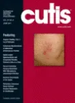 Erythema multiforme-like fixed drug eruption